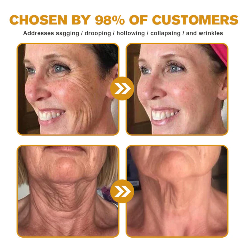 đ¨ââď¸ Botox Bee Venom Wrinkle Removal Cream- LAST DAY 70% OFFâ