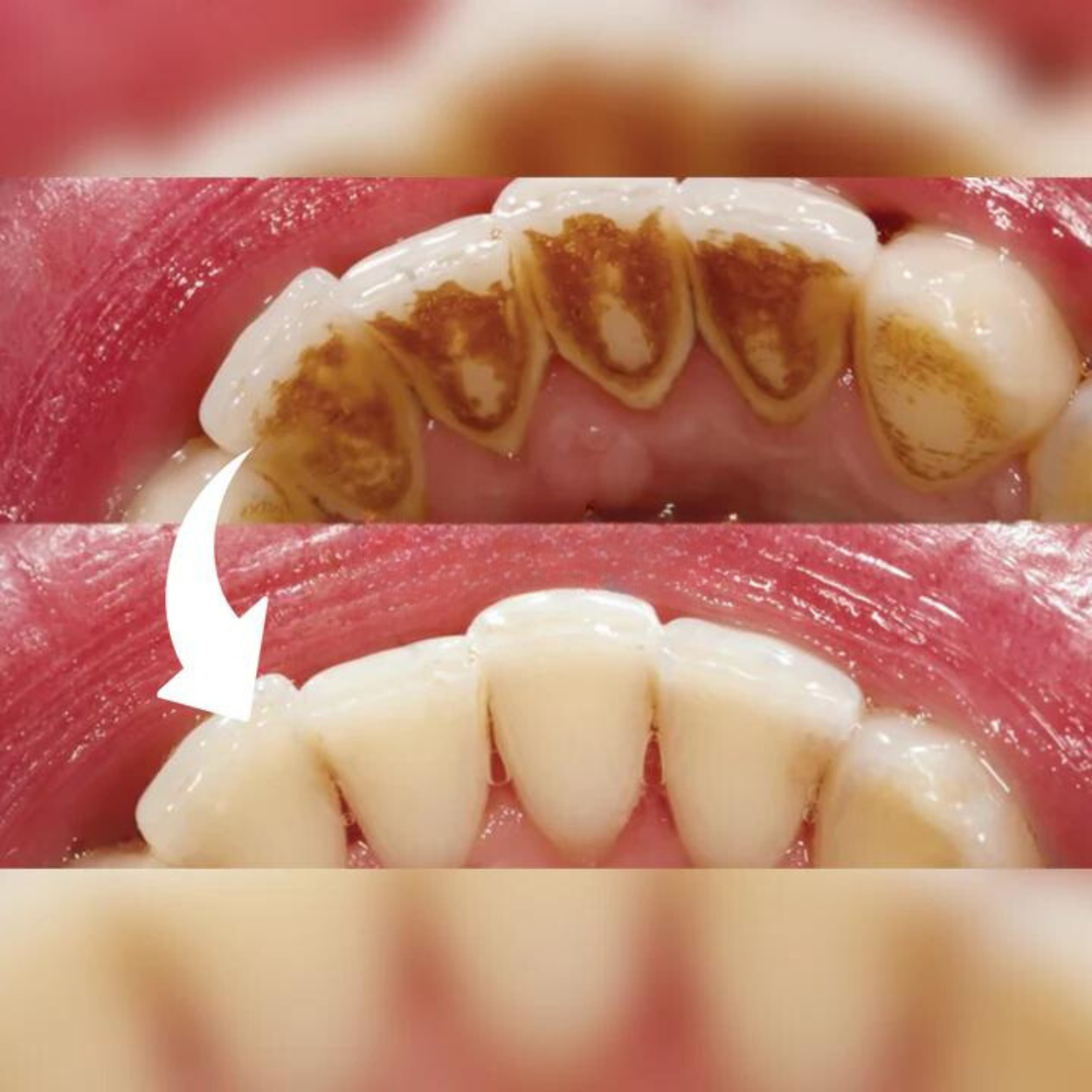 HEALIX | Dental Remover for perfect oral hygiene