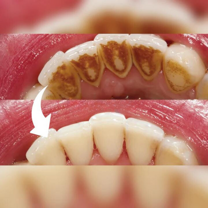 HEALIX | Dental Remover for perfect oral hygiene